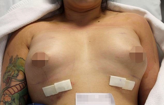 "Пузыри": женщина копила на пластику груди пять лет и сразу пожалела