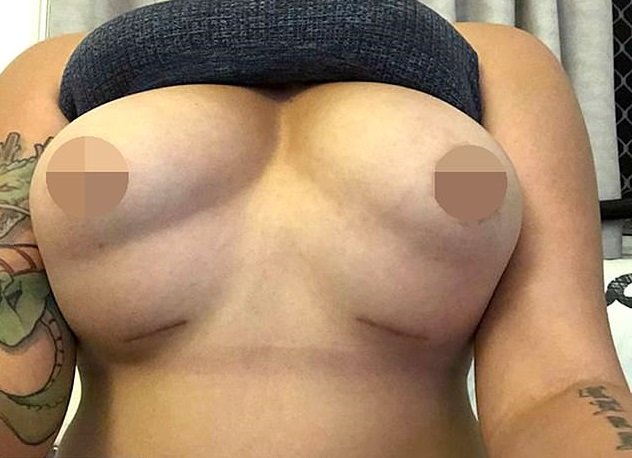 "Пузыри": женщина копила на пластику груди пять лет и сразу пожалела
