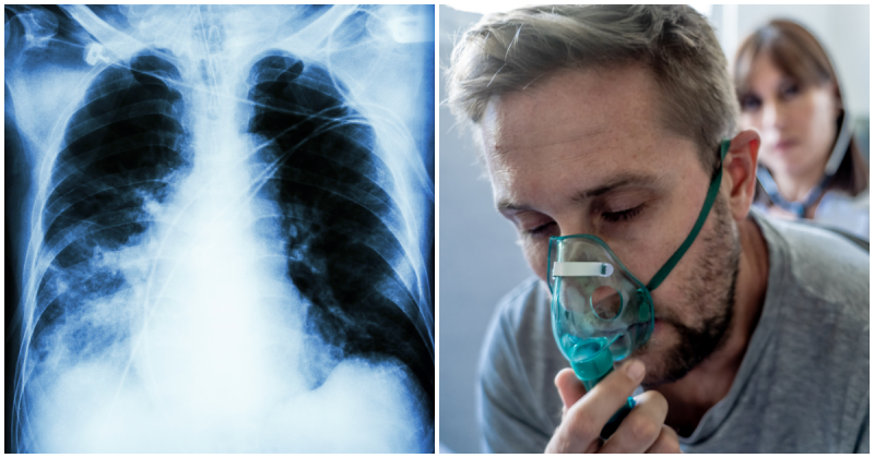 Пневмония: симптомы и признаки воспаления легких у детей и взрослых, лечение