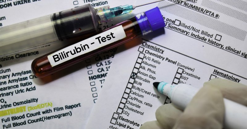 Билирубин - что это значит? Повышен билирубин - это признак болезни?