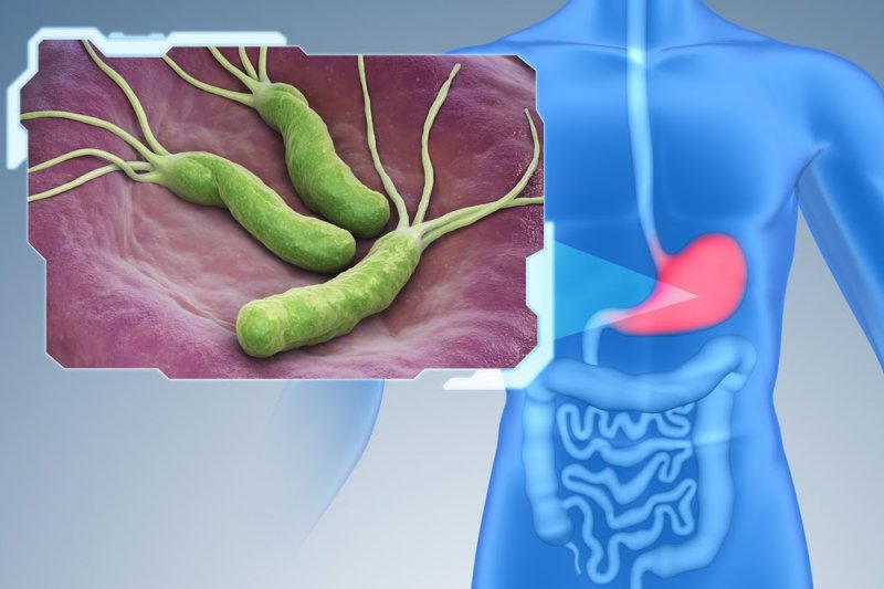Гастрит: причины, симптомы и лечение Helicobacter pylori