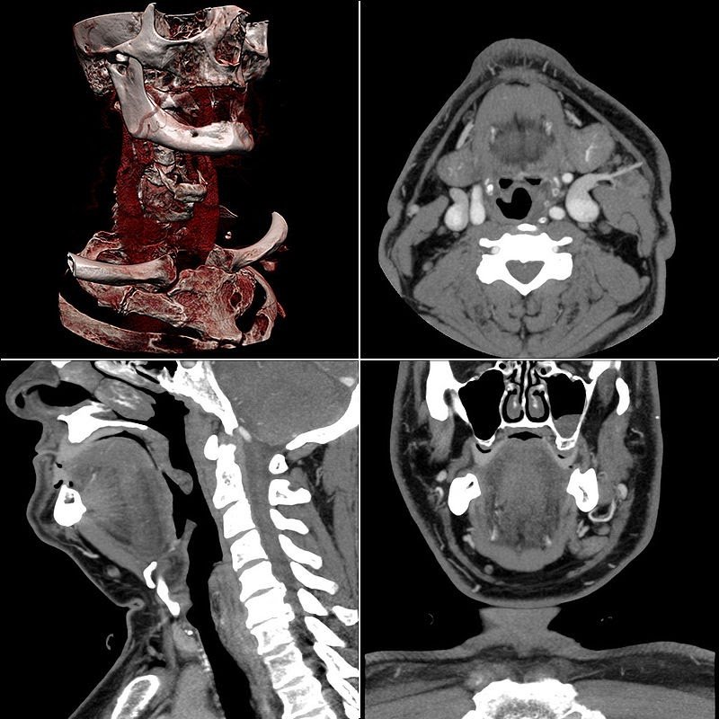 Мскт что это. Мультиспиральная компьютерная томография (МСКТ). Мультиспиральная многослойная компьютерная томография. Многослойная компьютерная томография (МСКТ). Мягкие ткани шеи кт анатомия.