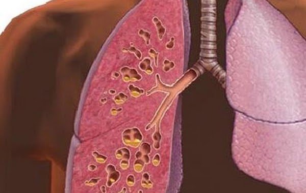 Что значит процент поражения лёгких при коронавирусе и чем он грозит