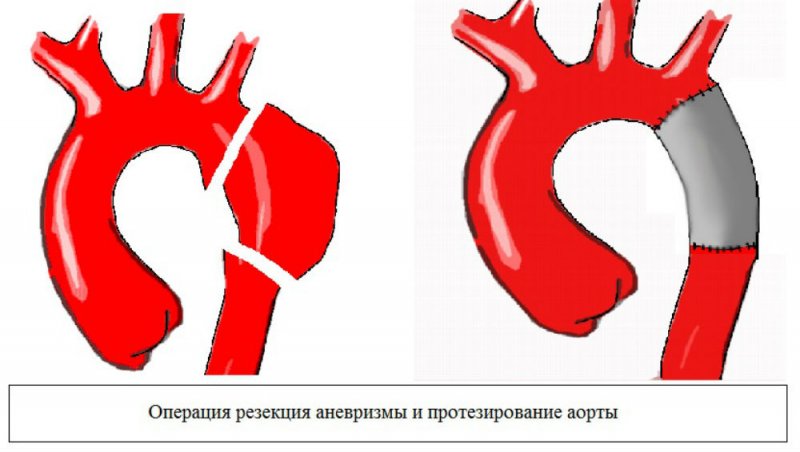 Причина смерти Сергея Доренко. Что такое аневризма и разрыв аорты?