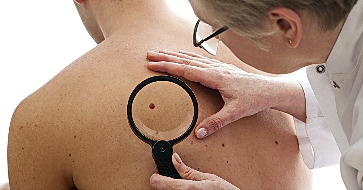 Дерматологи раскрыли, как избежать смертельно опасного рака кожи