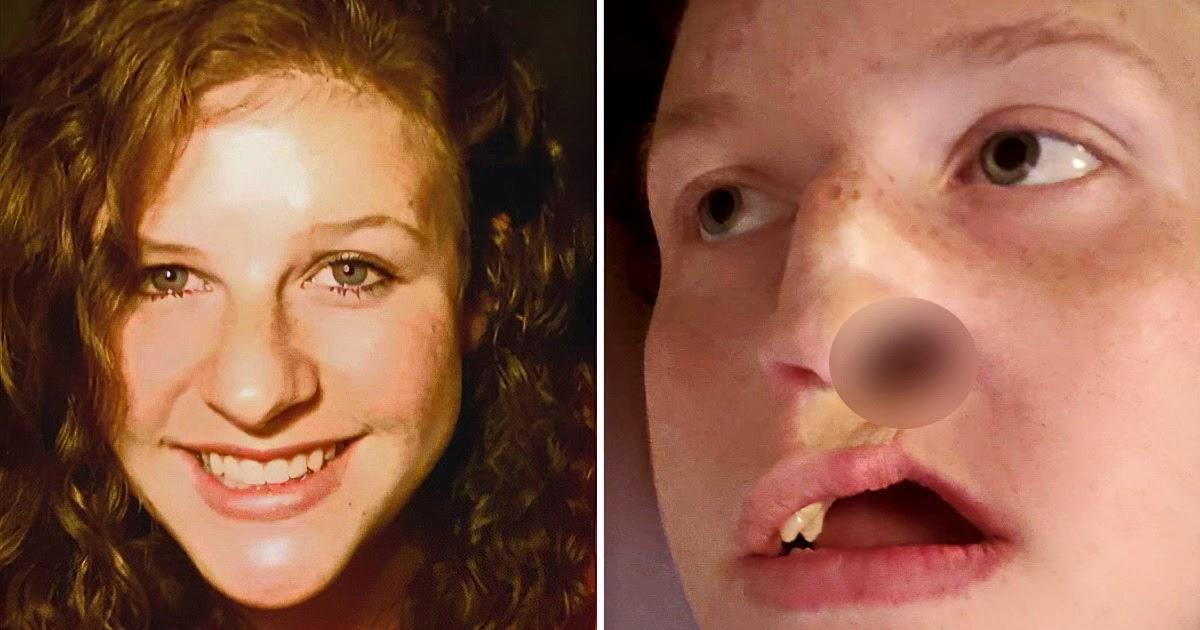 Прыщ на носу девушки, оказавшийся опухолью, привел к реконструкции лица
