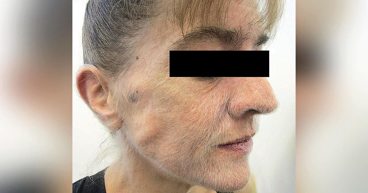 Австралийка курила 37 лет, и ее лицо покрылось волосами