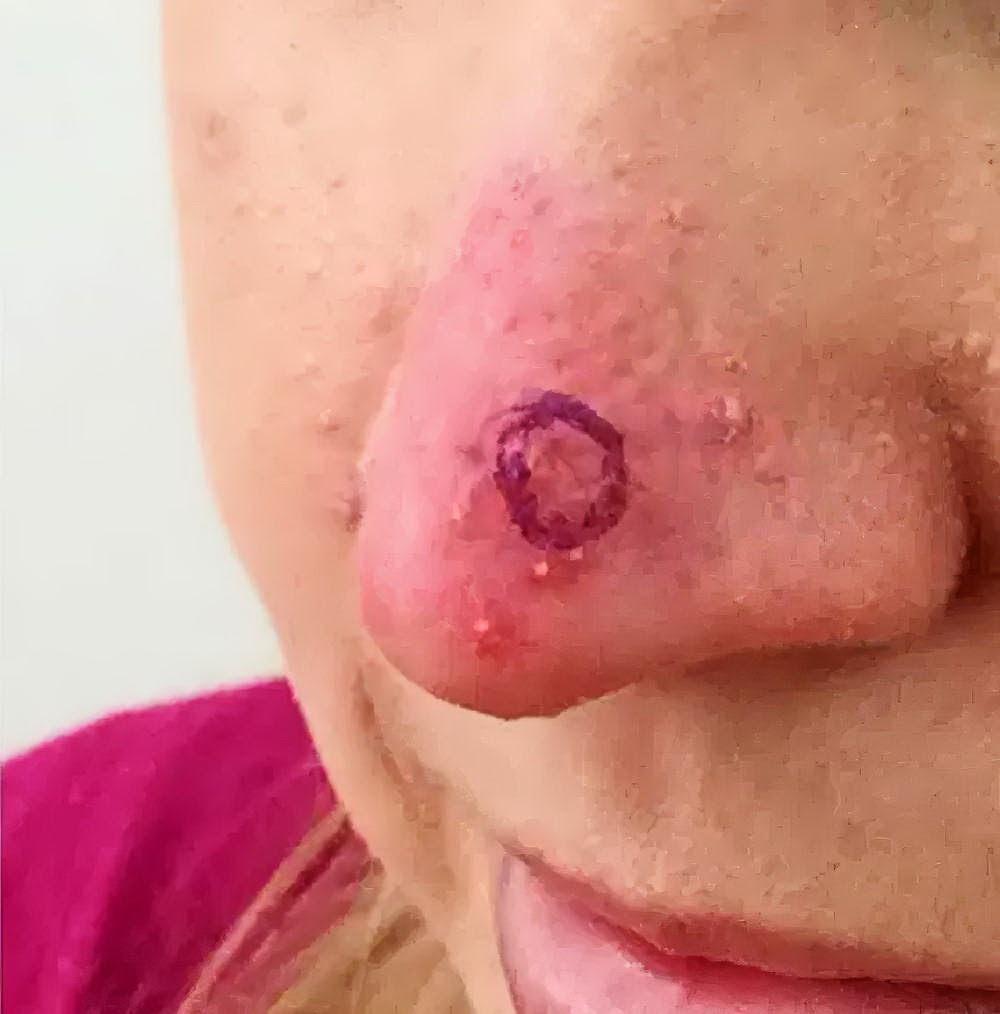 Австралийка считала опухоль прыщом и оказалась с дырой в носу