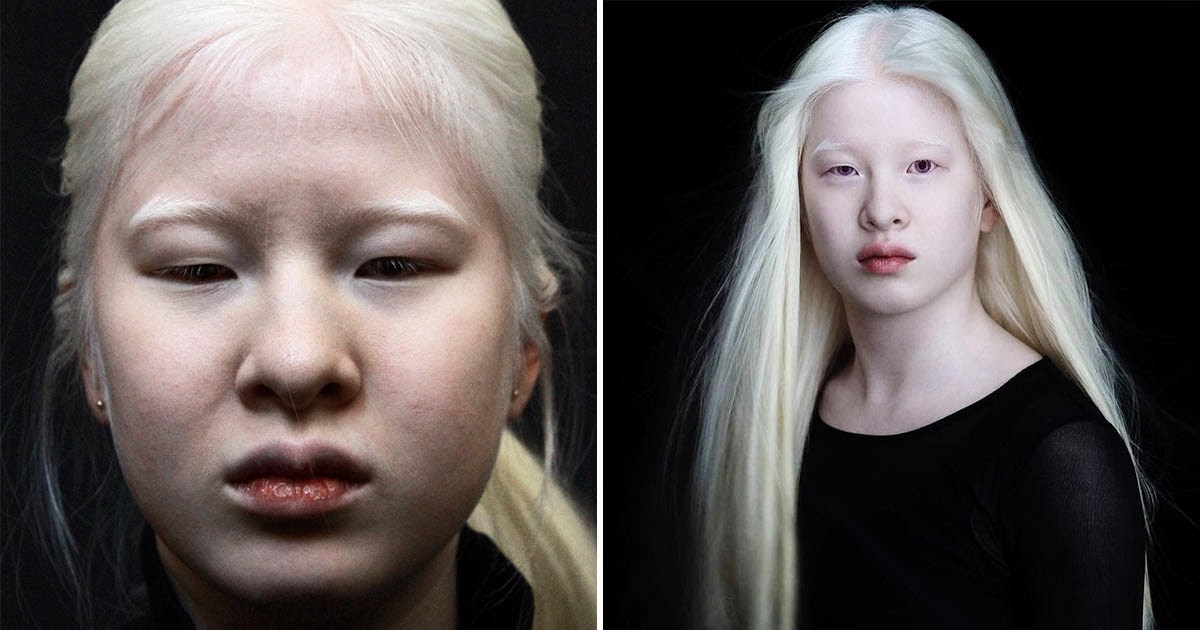 Девочка-альбинос, брошенная родителями на пороге приюта, стала моделью
