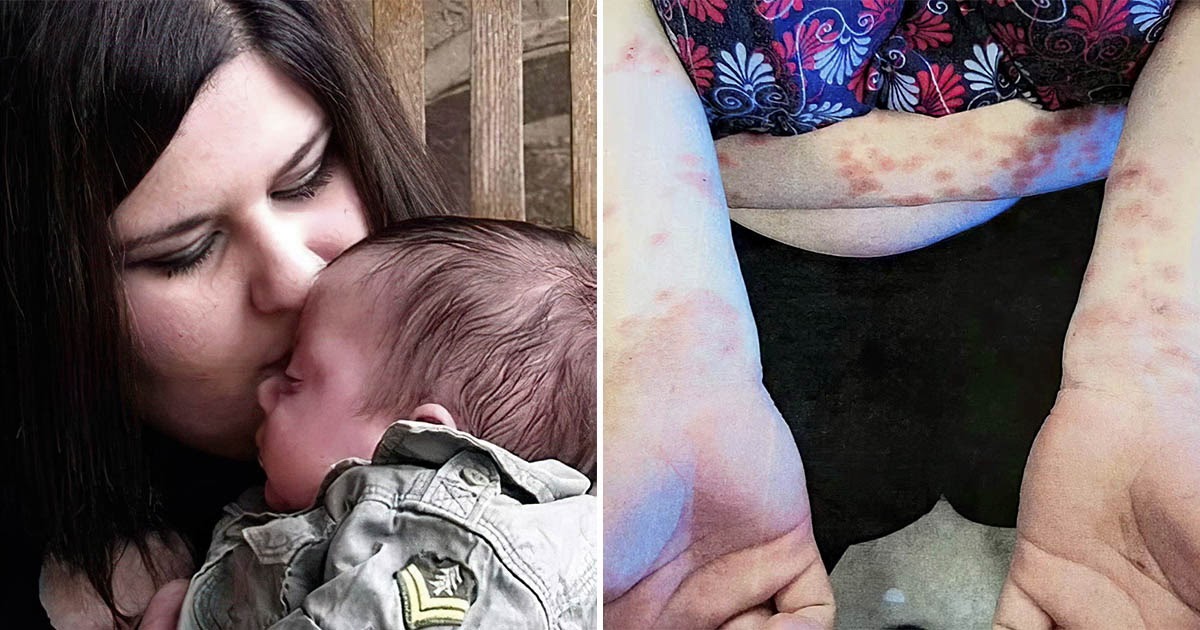 Аллергия на собственную кожу заставила американку ходить без одежды