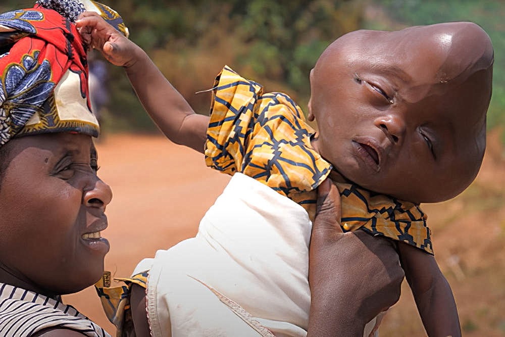 Африканка родила ребенка с головой в форме груши и потеряла мужа и работу