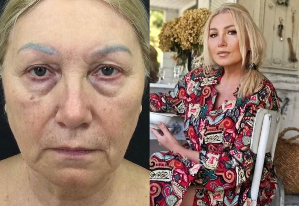 62-летняя россиянка сделала пластику после гибели мужа и помолодела вдвое