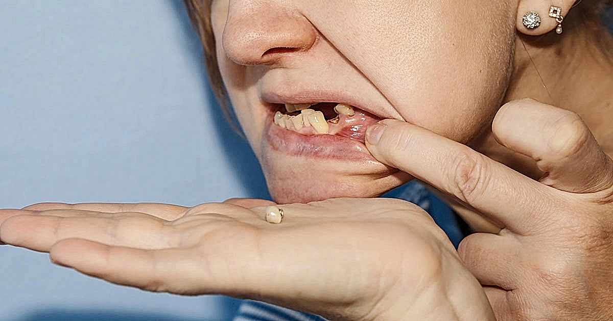 Британка осталась без бесплатного стоматолога и вырвала себе 11 зубов