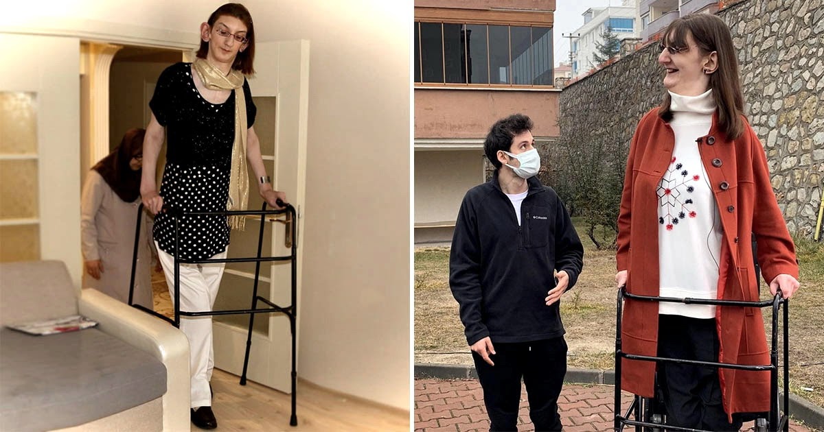 Крайне редкая болезнь сделала турчанку самой высокой женщиной в мире